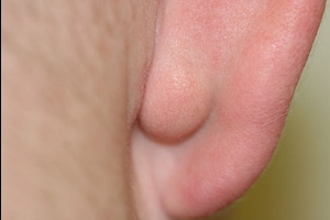 Шишка и прыщ (жировик) на мочке ушей, причина возникновения