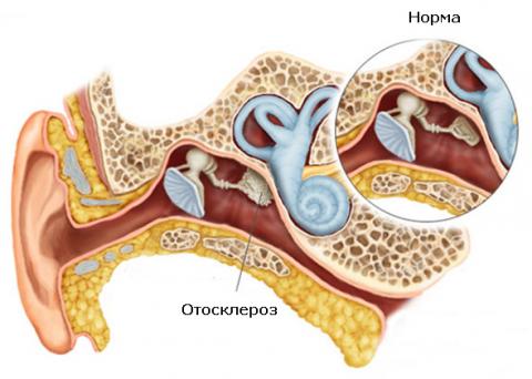 Отосклероз уха - как лечить недуг 