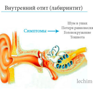 Внутренний отит – заболевание ушного лабиринта